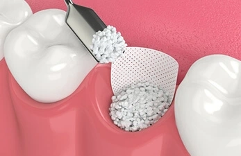 Bone Grafting Bone Grafting