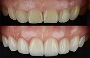 Crown Lengthening Crown Lengthening