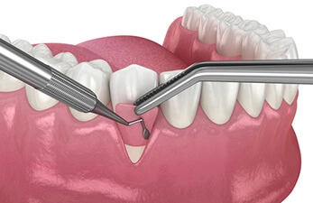 Gum Grafting Gum Grafting