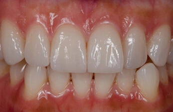 Gum Surgery Gum Surgery