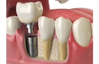 Single Dental Implant