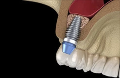 Sinus Lift Implant Placed