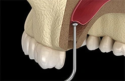 Sinus Lift Sinus Lift